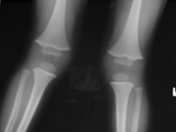 Absent Patella-Fongs