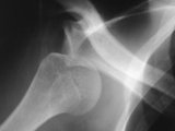 Anterior dislocation-shoulder