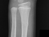 Fx-Buckle-radius and ulna