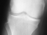Chondrocalcinosis-knee
