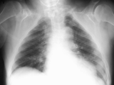 Cleidocranial dysotosis