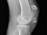 Fx-patella