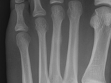 Fx-stress-3rd metatarsal