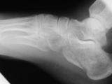 Fx calcaneous-jumper