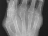 Gout-hand