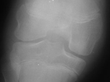 Hemophilac arthropathy