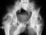 Heterotopic Ossification-hips