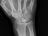 Keinboch's osteomalacia