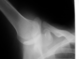 Luxatio erecta-inf dislocation shoulder