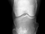 Multiple hereditary exostoses-knee