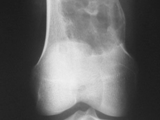 Non-ossifying fibroma