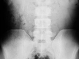 Ossification in scar