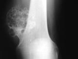 Osteochondroma-femur