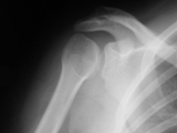 Posterior dislocation-shoulder