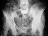 Prostate mets-pelvis