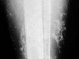 Stasis periosititis