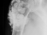 Synovial chondromatosis