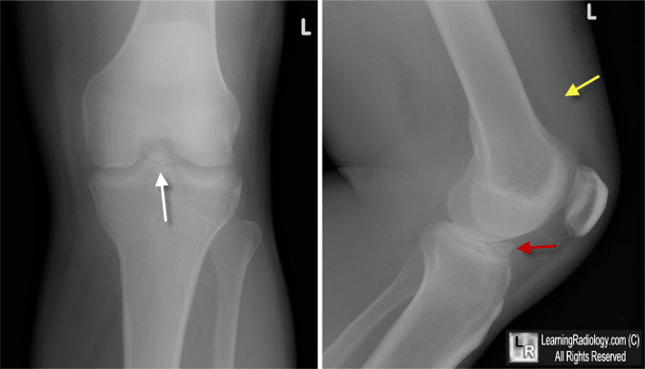 Intercondylar Eminence Fracture