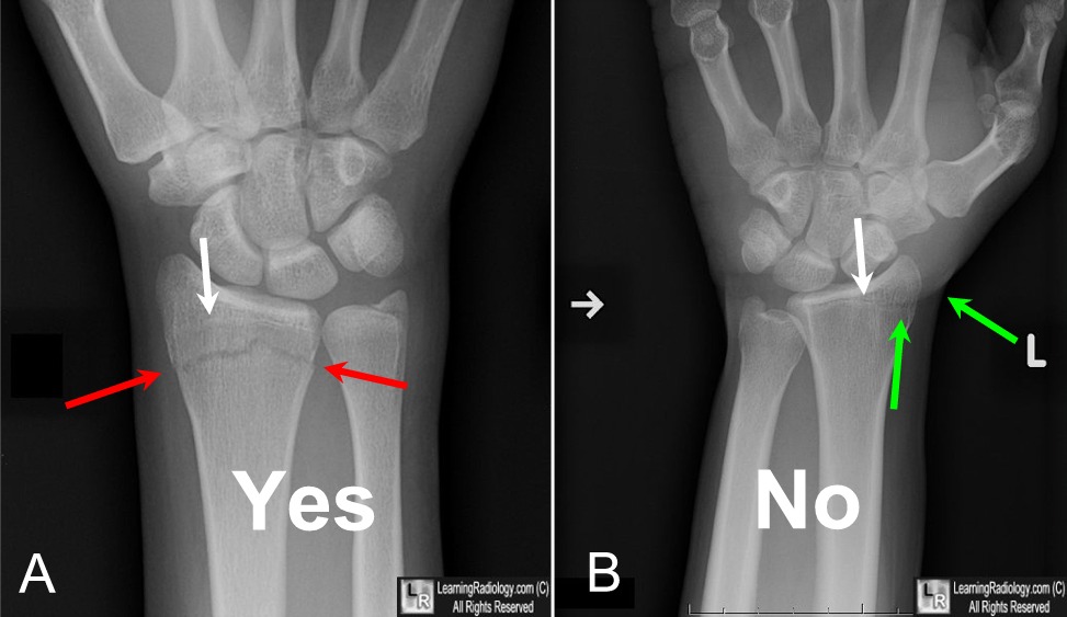 Learning Radiology - Fracture or Not Fracture