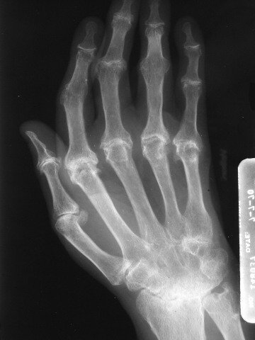 Arthritis of the Hands