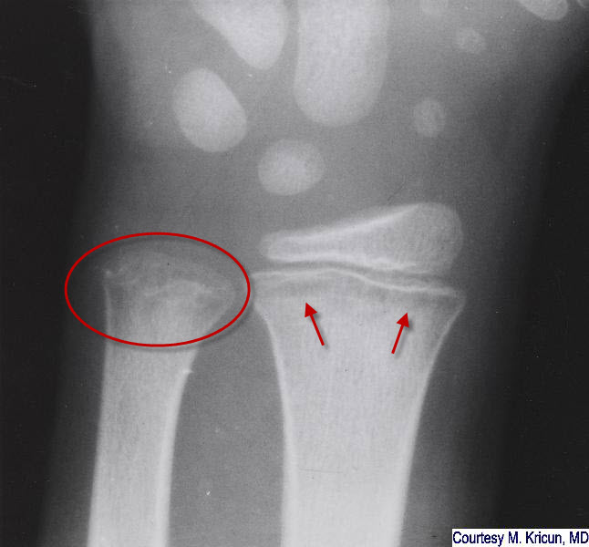 Lucent Metaphyseal Bands in Leukemia