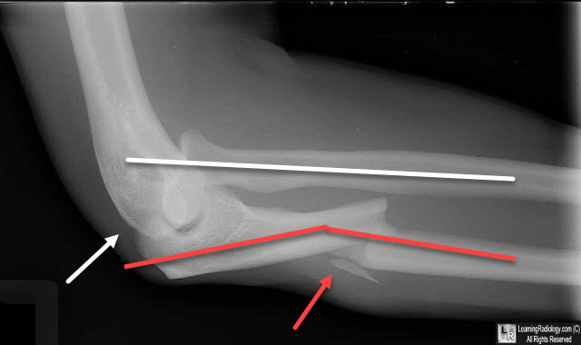 Monteggia Fracture Dislocation