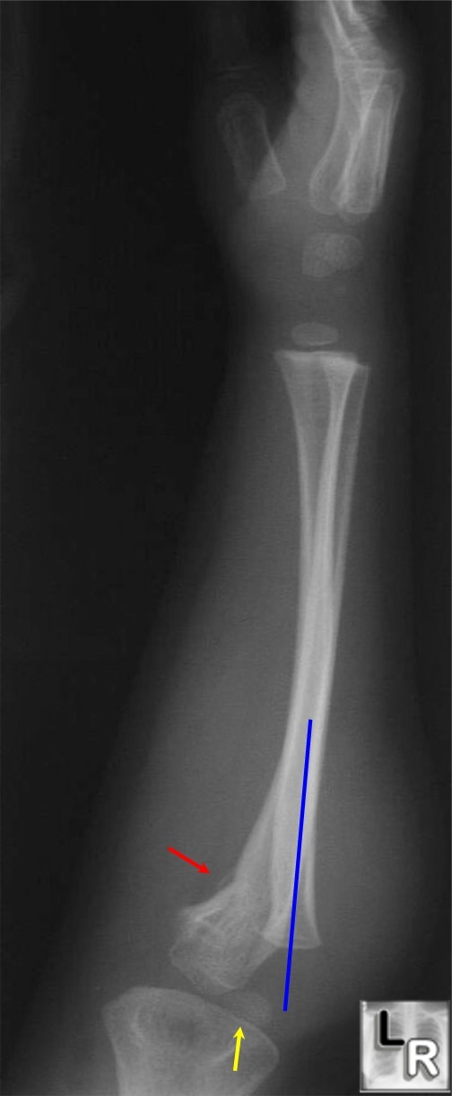 Monteggia fracture