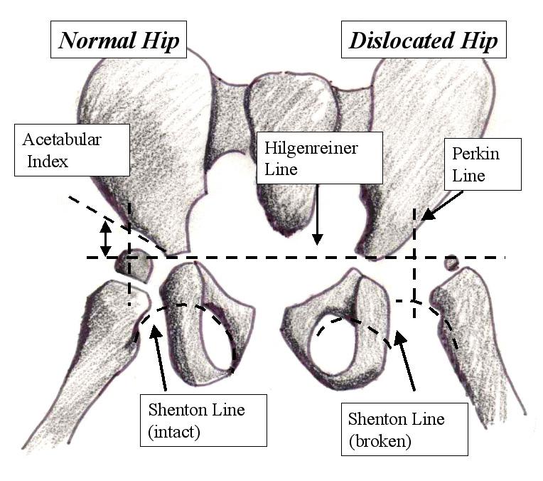 congenital hip dysplasia