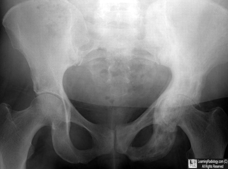 Paget's Disease -- pelvis