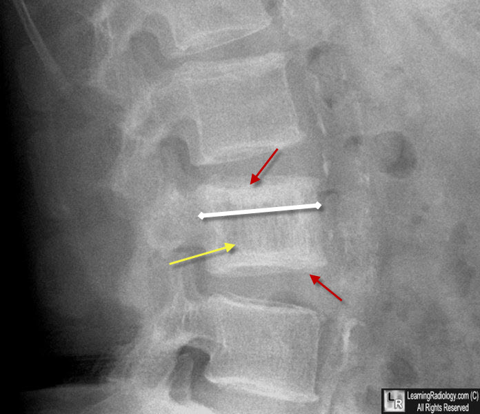 Paget Disease of Spine