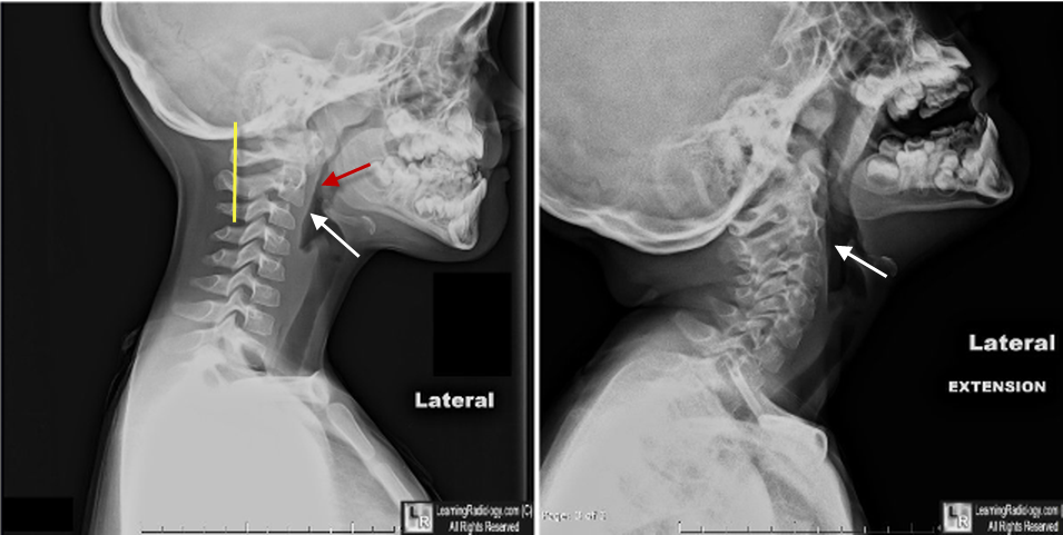 Pseudosubluxation C2 on C3