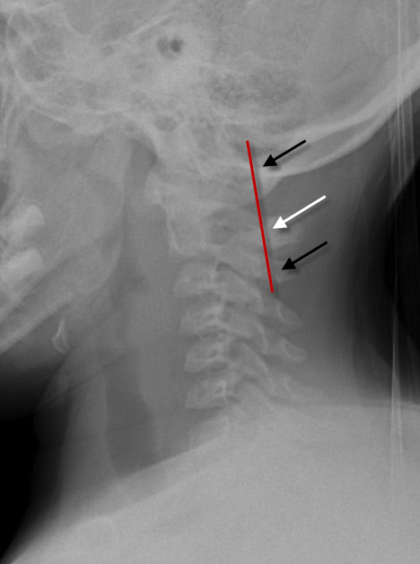 Posterior Cervical Line.