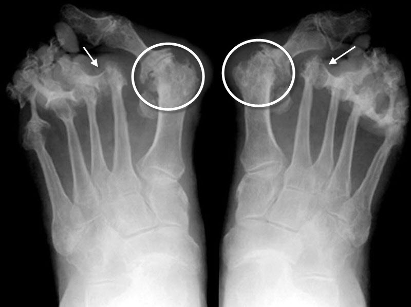 Rheumatoid Arthritis, both feet