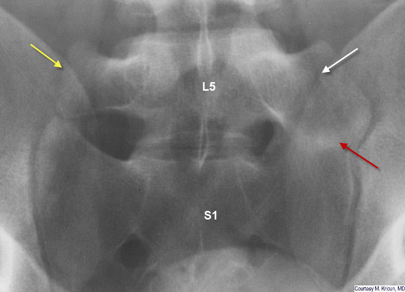 Sacralization of L5