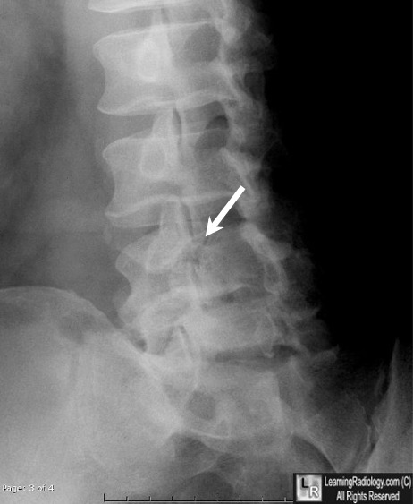 Spondylolysis