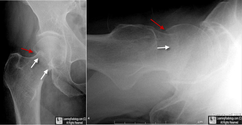 sub-capital hip fracture