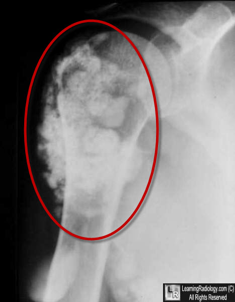 Learning Radiology - Synovial Osteochondromatosis, Chondromatosis