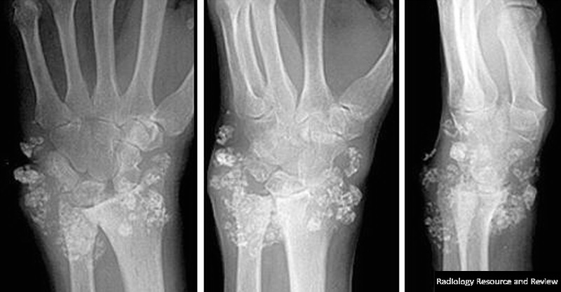 Synovial Chondromatosis