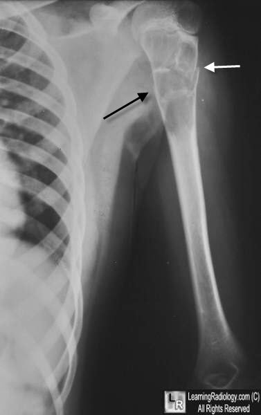 Unicameral Bone Cyst
