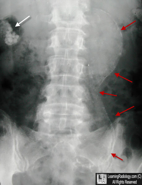 Abdominal Aortic Aneurysm