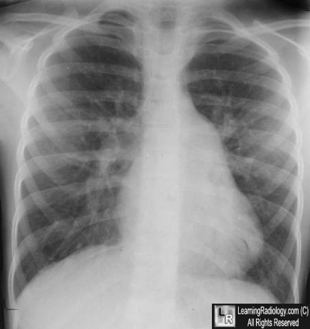 Atrial Septal Defect