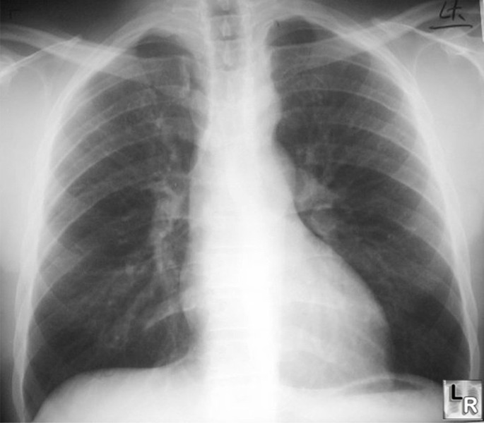 Coarctation of the Aorta