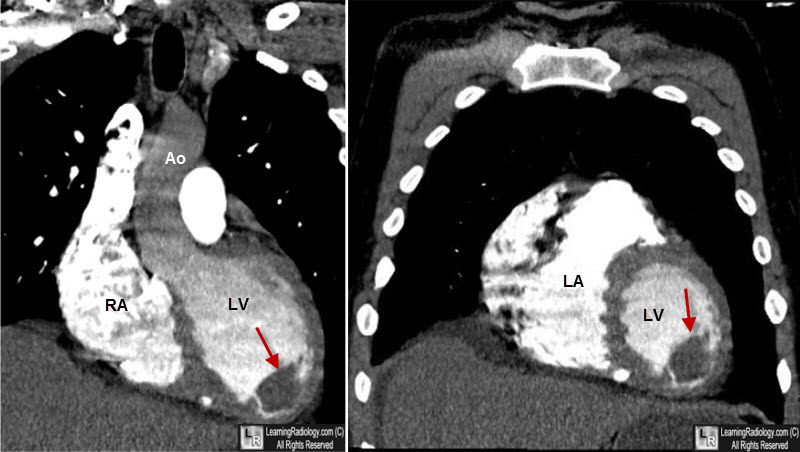 Left Ventricular Thrombus