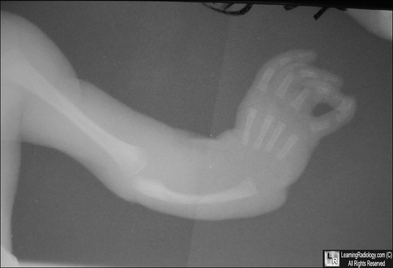 Holt-Oram Syndrome