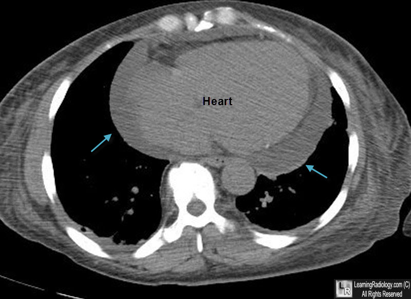 pericardial effusion