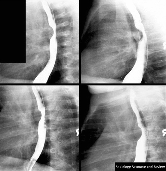 pulmonary sling