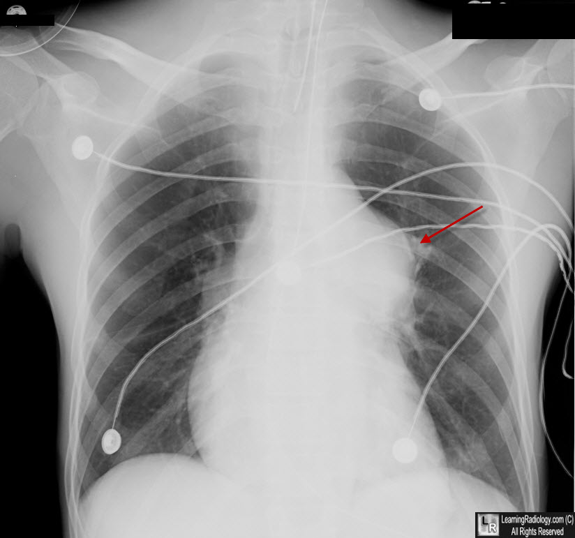 pulmonic stenosis