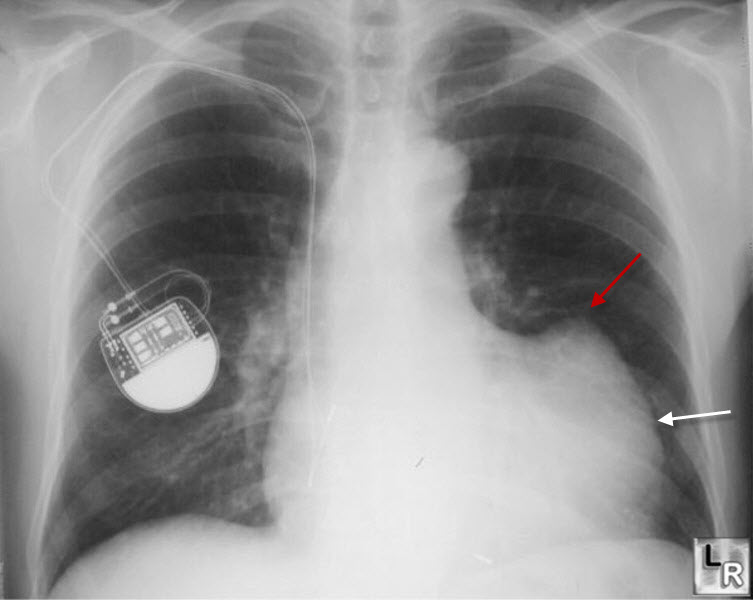 ventricular aneurysm