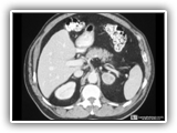 Adrenal adenoma-066