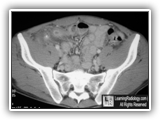 Acute appendicitis-063